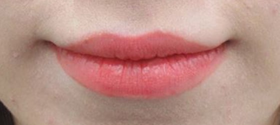 M字リップ形成術と口角リフトを組み合わせて可愛い口元へ 症例写真 Taクリニック 美容整形 美容外科 新宿 銀座 大阪 福岡 高崎