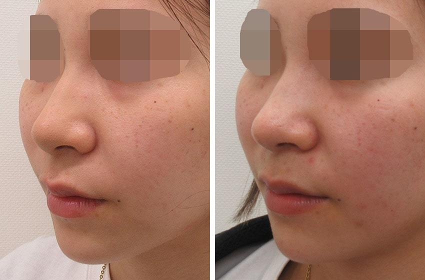 鼻尖形成・鼻尖縮小/鼻尖4Dノーズの症例写真 施術前後 ３週間