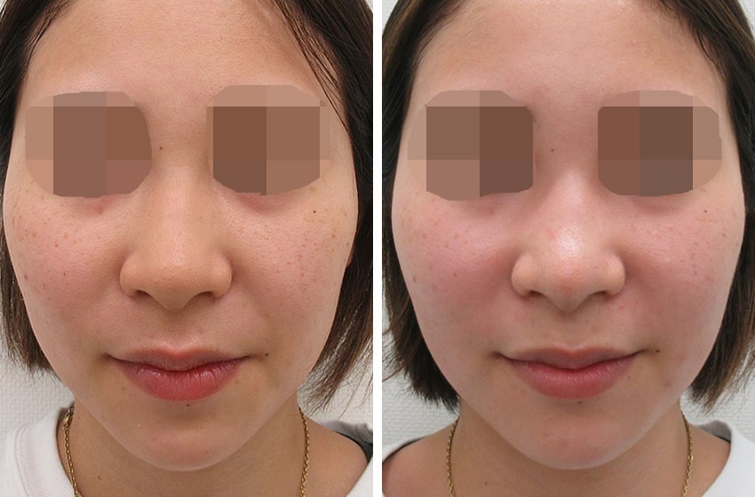 鼻尖形成・鼻尖縮小/鼻尖4Dノーズの症例写真 施術前後 ３週間