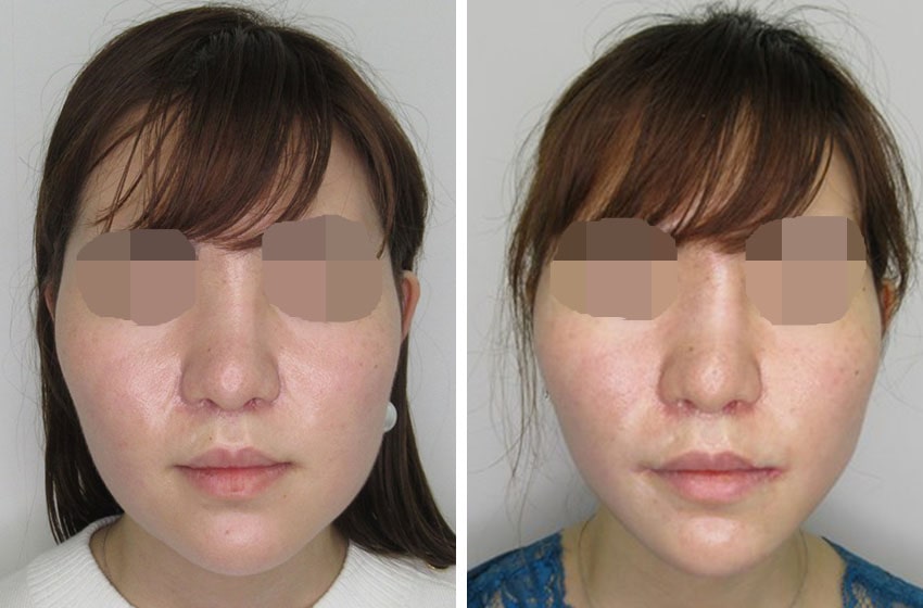 メーラーファット除去/ジョールファット除去/TAC式 ツヤ肌コラーゲンリフト®の症例写真 施術前後 １ヵ月