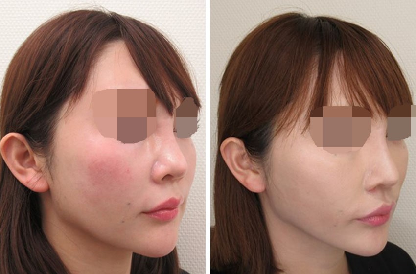 TAC式 ツヤ肌コラーゲンリフト®/ジョールファット除去/TAC式 鼻翼縮小術（小鼻縮小）の症例写真 施術前後 １ヵ月