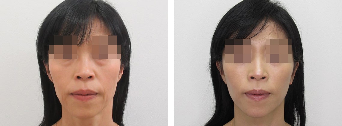 フェイスリフト（切開）の症例写真 施術前後 １ヵ月