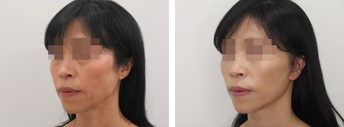 フェイスリフト（切開）の症例写真 施術前後 １ヵ月