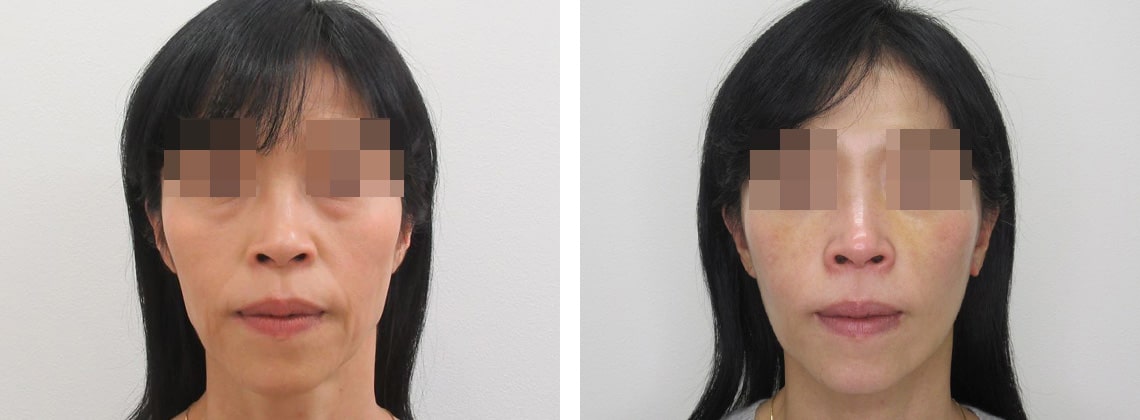 フェイスリフト（切開）の症例写真 施術前後 １週間