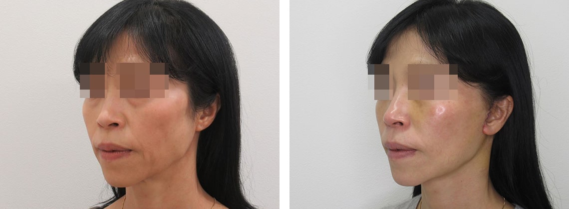 フェイスリフト（切開）の症例写真 施術前後 １週間