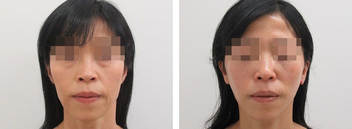 フェイスリフト（切開）の症例写真 施術前後 ２日