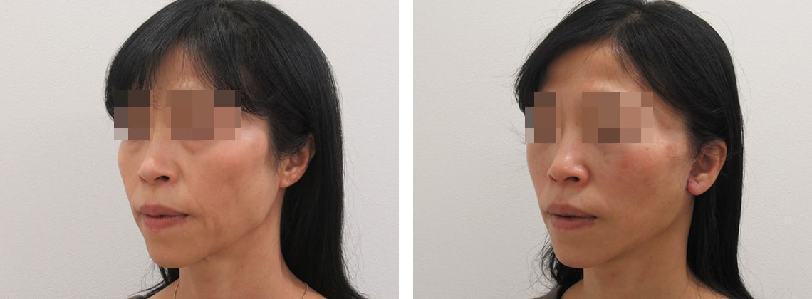 フェイスリフト（切開）の症例写真 施術前後 ２日