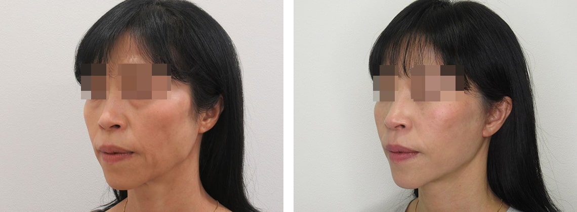 フェイスリフト（切開）の症例写真 施術前後 ２ヵ月