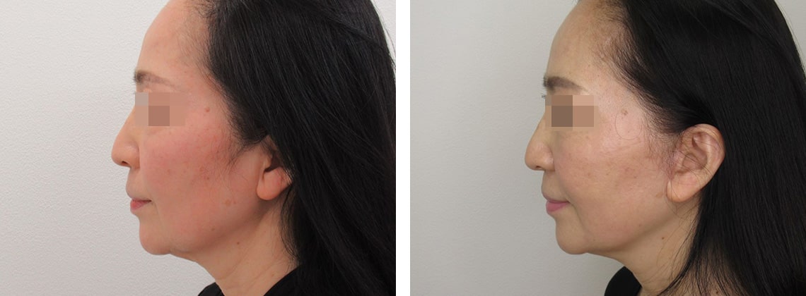 フェイスリフト（切開）/顎下の脂肪吸引の症例写真 施術前後 ３ヵ月
