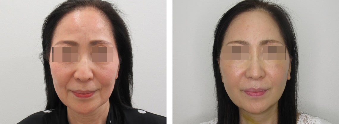 フェイスリフト（切開）/顎下の脂肪吸引の症例写真 施術前後 ９日