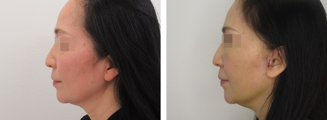 フェイスリフト（切開）/顎下の脂肪吸引の症例写真 施術前後 ９日