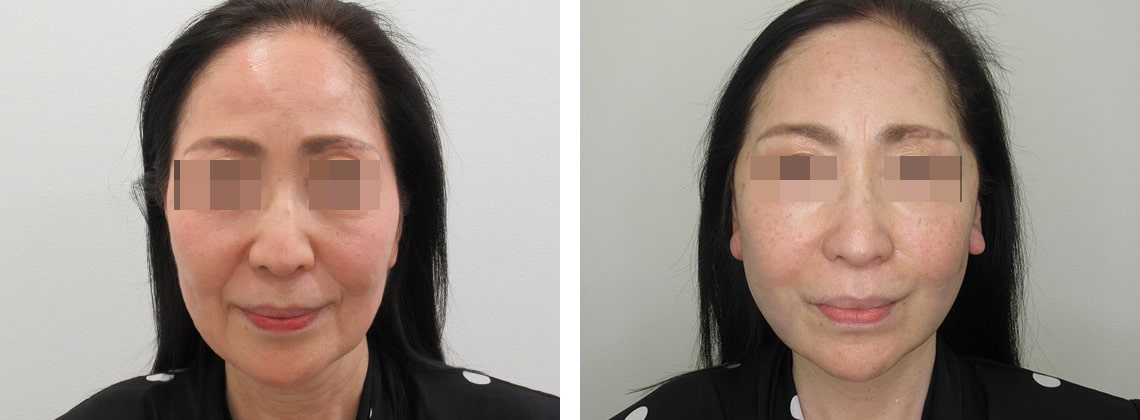 フェイスリフト（切開）/顎下の脂肪吸引の症例写真 施術前後 直後