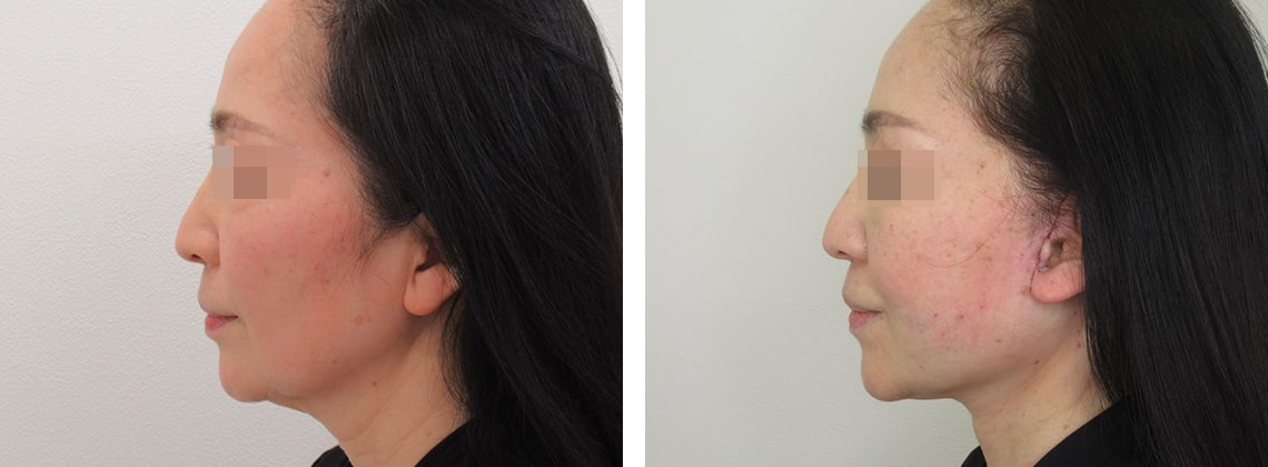 フェイスリフト（切開）/顎下の脂肪吸引の症例写真 施術前後 直後