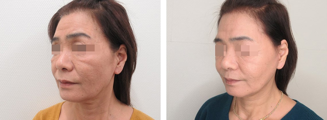 フェイスリフト（切開）の症例写真 施術前後 １ヵ月