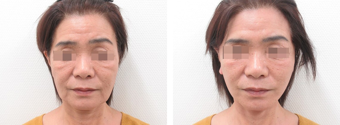フェイスリフト（切開）の症例写真 施術前後 直後