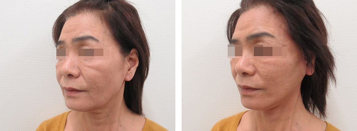 フェイスリフト（切開）の症例写真 施術前後 直後