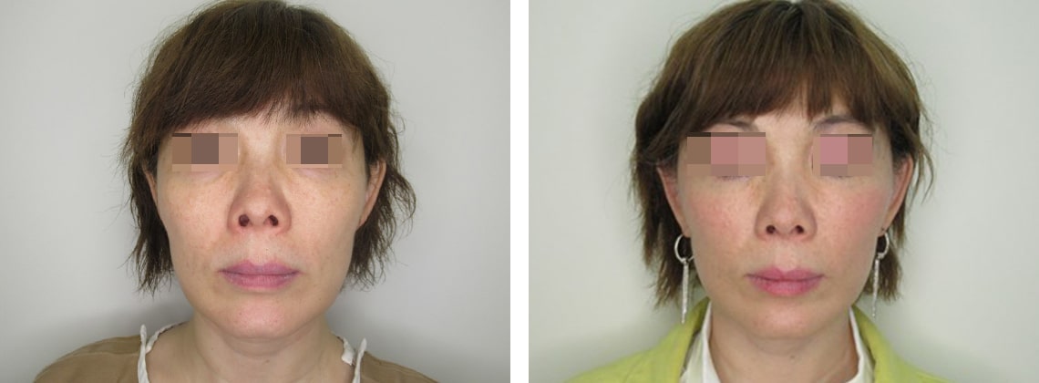 フェイスリフト（切開）の症例写真 施術前後 １ヵ月
