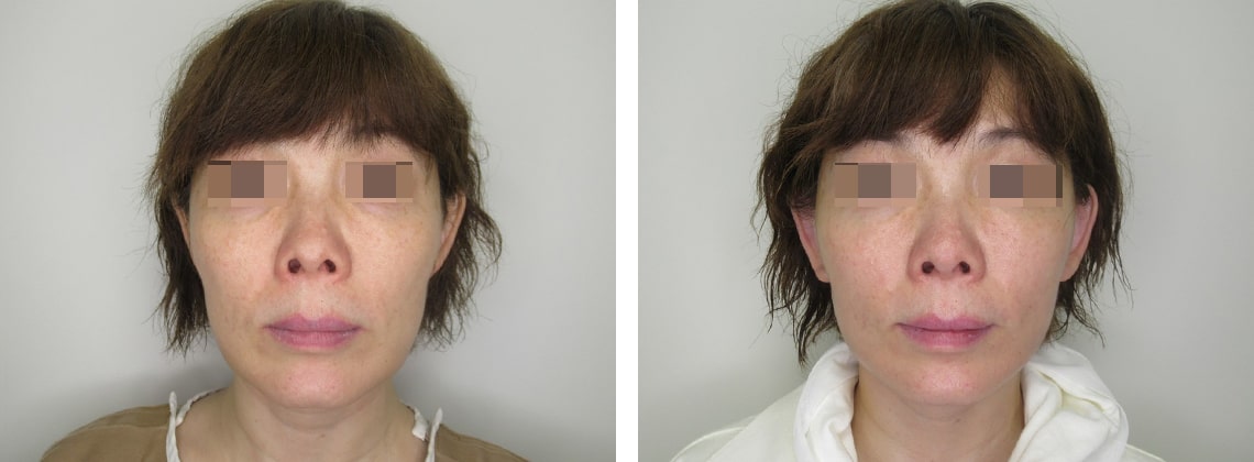 フェイスリフト（切開）の症例写真 施術前後 １週間