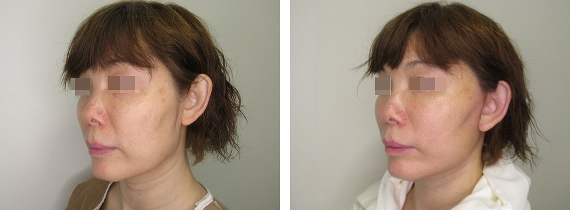 フェイスリフト（切開）の症例写真 施術前後 １週間