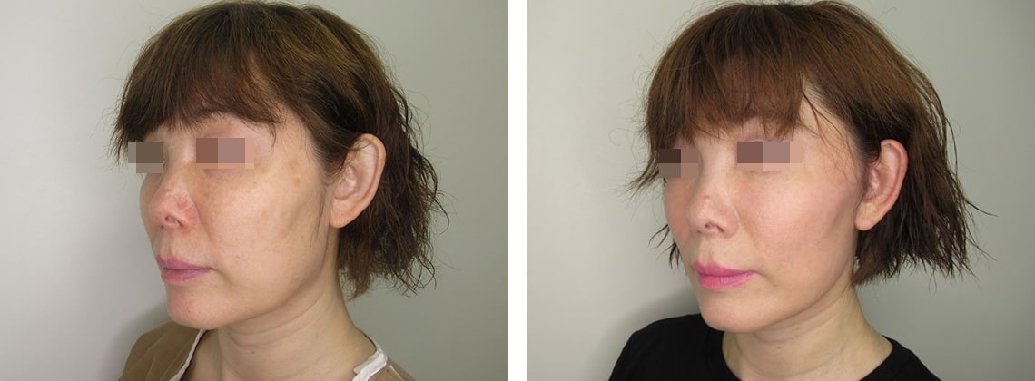 フェイスリフト（切開）の症例写真 施術前後 ４ヵ月