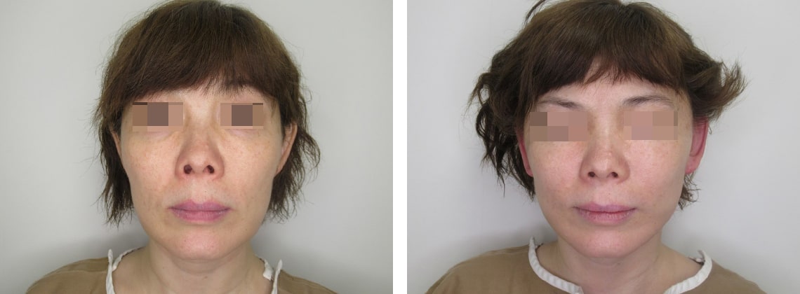 フェイスリフト（切開）の症例写真 施術前後 直後