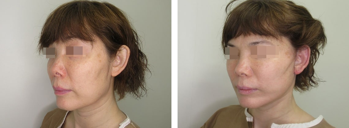 フェイスリフト（切開）の症例写真 施術前後 直後
