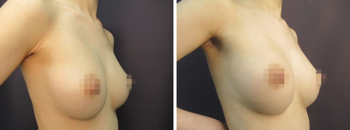 ヒアルロン酸注入豊胸術（グラビアバスト）の症例写真 施術前後 1週間後