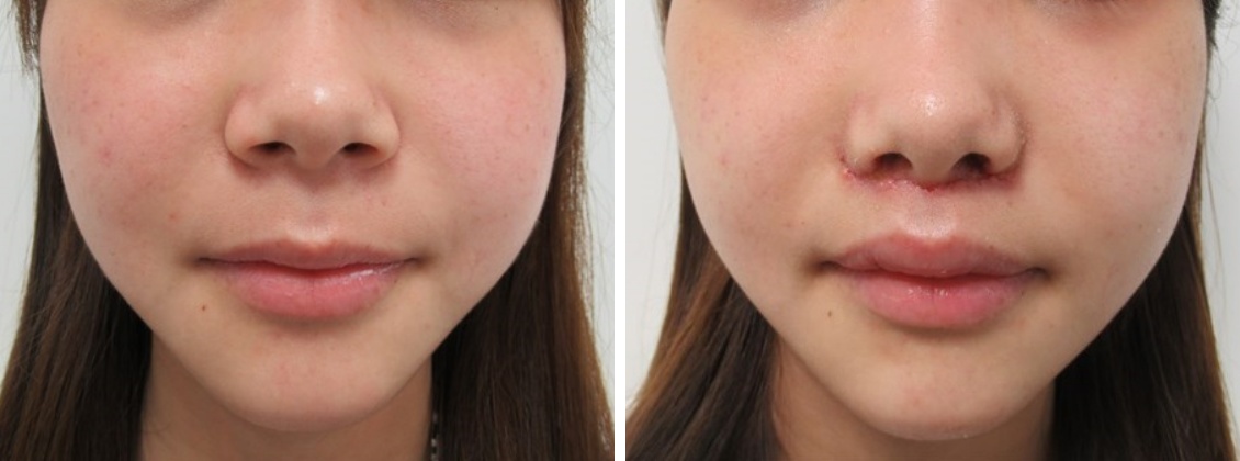 人中短縮術(リップリフト)・外側人中短縮術の症例写真 施術前後 １週間後