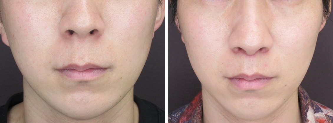 人中短縮術(リップリフト)・外側人中短縮術の症例写真 施術前後 1ヵ月
