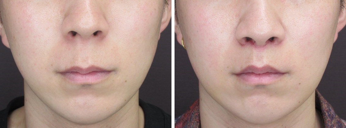 人中短縮術(リップリフト)・外側人中短縮術の症例写真 施術前後 1週間後