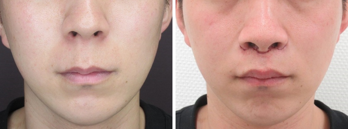人中短縮術(リップリフト)・外側人中短縮術の症例写真 施術前後 直後