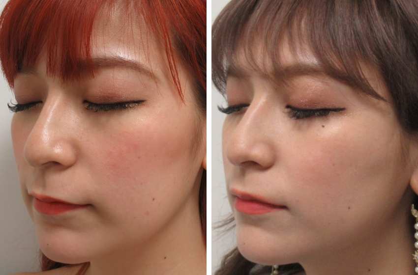 TAC式 ツヤ肌コラーゲンリフト®/バッカルファット除去の症例写真 施術前後 １ヵ月後