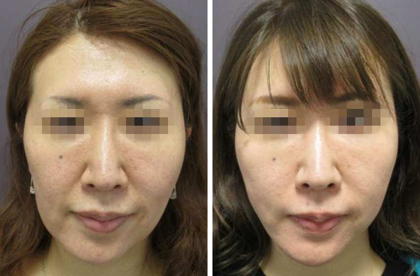 ほうれい線が薄くなり、輪郭の左右差も改善
