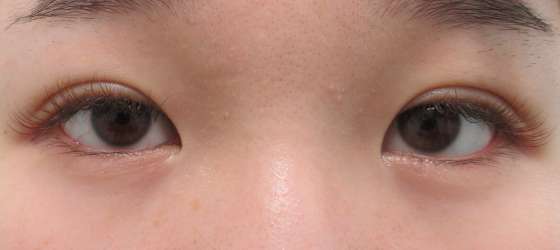 症例写真 ダウンタイム 蒙古襞が強く目の横幅が狭い方の埋没二重 Taクリニック 美容整形 美容外科 新宿 銀座 横浜 大阪 福岡 川越 高崎 Taクリニック 美容整形 美容外科