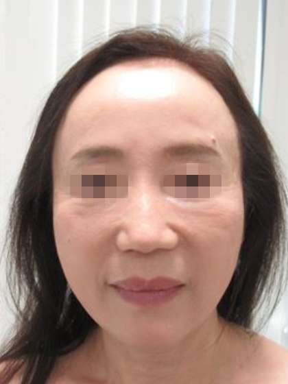 ハリのある卵型の輪郭へ 症例写真 Taクリニック 美容整形 美容外科 新宿 銀座 大阪 福岡 高崎