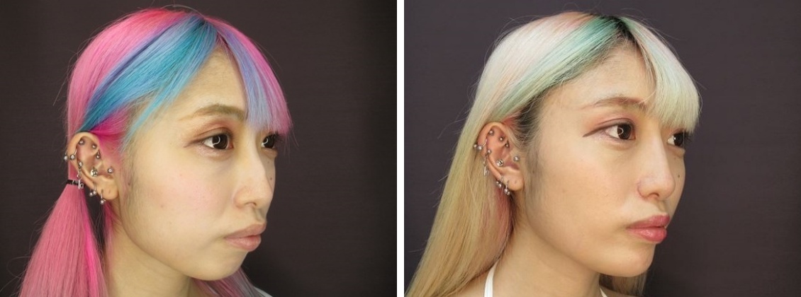 TAC式 ツヤ肌コラーゲンリフト®/バッカルファット除去/TAC式 鼻翼縮小術(小鼻縮小)の症例写真 施術前後 1ヵ月後