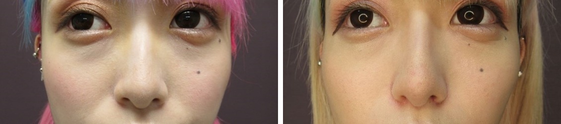 TAC式 ツヤ肌コラーゲンリフト®/バッカルファット除去/TAC式 鼻翼縮小術(小鼻縮小)の症例写真 施術前後 1ヵ月後