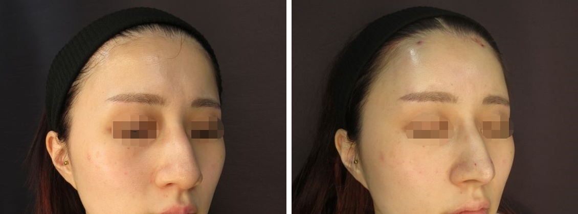 おでこの脂肪注入（オルチャンデコ形成）/おでこ・こめかみのヒアルロン酸注射/鼻尖4Dノーズの症例写真 施術前後 直後