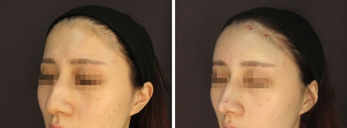 おでこの脂肪注入（オルチャンデコ形成）/おでこ・こめかみのヒアルロン酸注射/鼻尖4Dノーズの症例写真 施術前後 直後