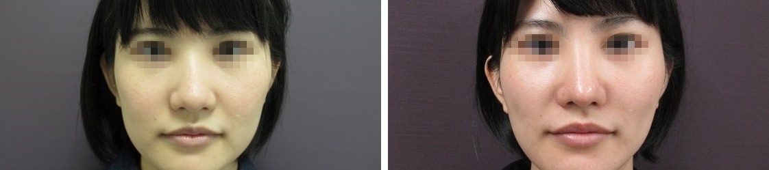 鼻尖4Dノーズ/鼻尖形成・鼻尖縮小/ジョールファット除去の症例写真 施術前後 1ヵ月後