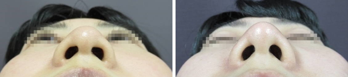 鼻尖4Dノーズ/鼻尖形成・鼻尖縮小/ジョールファット除去の症例写真 施術前後 1ヵ月後