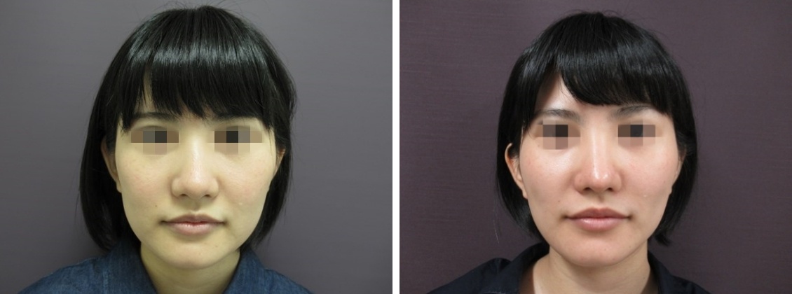 ジョールファット除去/メーラーファット除去/顔の脂肪吸引の症例写真 施術前後 1ヵ月後