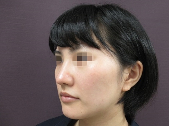 症例写真 ダウンタイム フェイスラインがはっきりする組み合わせ Taクリニック 美容整形 美容外科 新宿 銀座 横浜 大阪 福岡 川越 高崎 Taクリニック 美容整形 美容外科