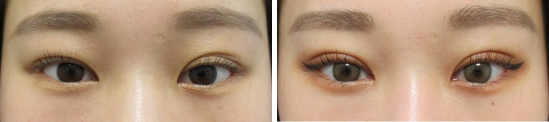 埋没で左右差を整える