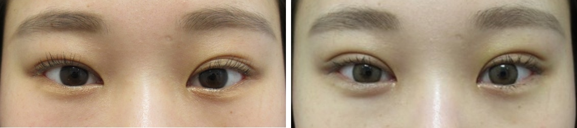 二重埋没法の症例写真 施術前後 1週間後（術後はカラーコンタクト使用）