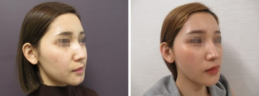 症例写真 ダウンタイム ツヤ肌輪郭美人になる組み合わせ Taクリニックグループ 美容整形 美容外科 全国展開中