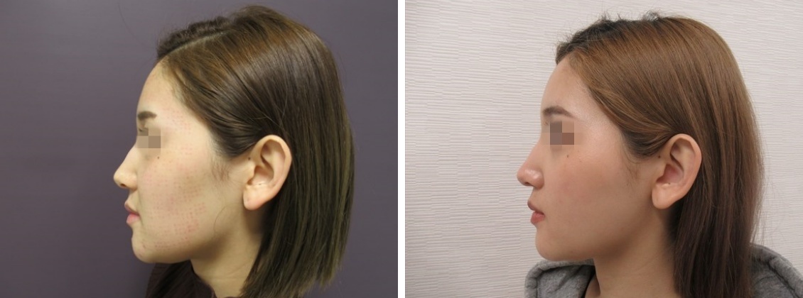 TAC式 ツヤ肌コラーゲンリフト®/ジョールファット除去/メーラーファット除去の症例写真 施術前後 ２ヵ月後