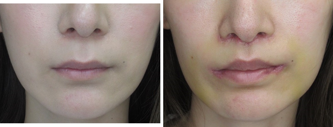 人中短縮術(リップリフト)・外側人中短縮術/口角挙上・リフト（マイクロ切開法・内側法/口内法）/ボトックス注射：その他の症例写真 施術前後 1週間