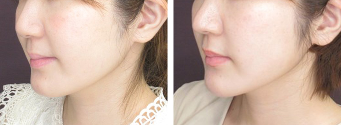 TAC式 ツヤ肌コラーゲンリフト®/バッカルファット除去/ジョールファット除去の症例写真 施術前後 １ヵ月