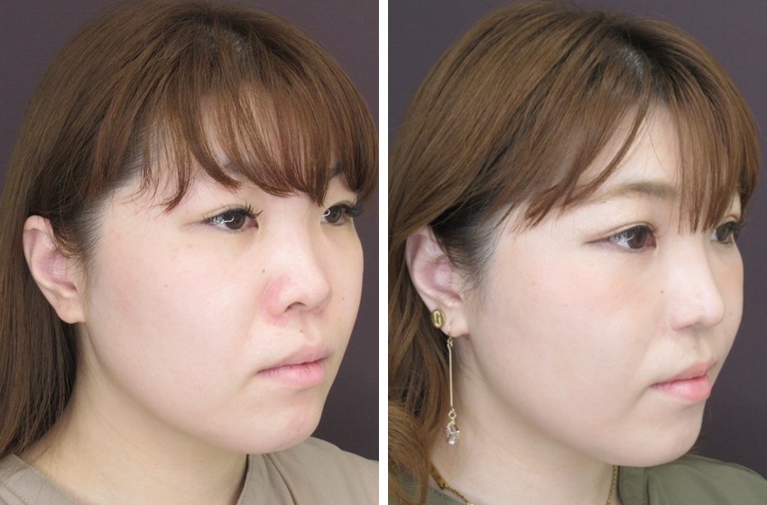 TAC式 鼻翼縮小術（小鼻縮小）/鼻翼挙上術/鼻孔縁挙上術の症例写真 施術前後 1ヵ月後